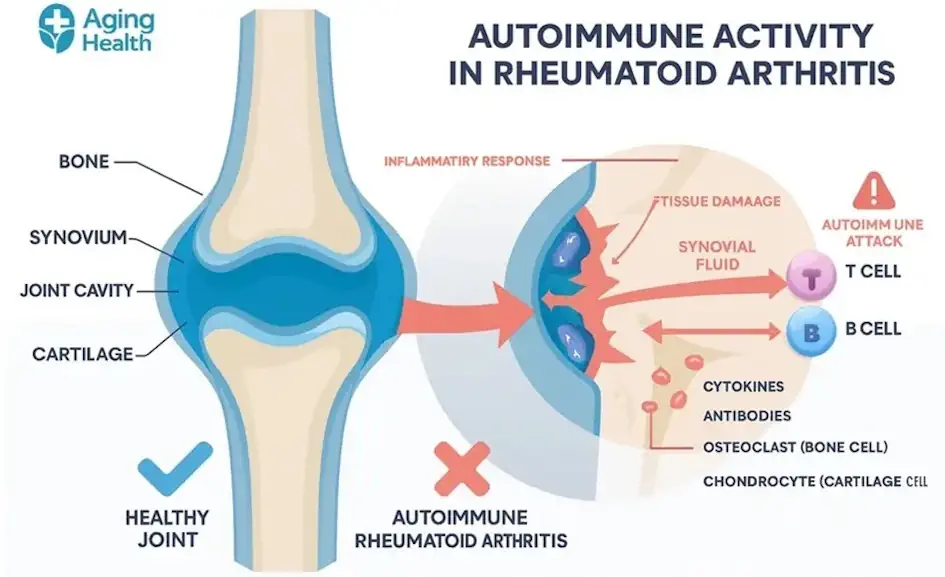 Autoimmune response in rheumatoid arthritis